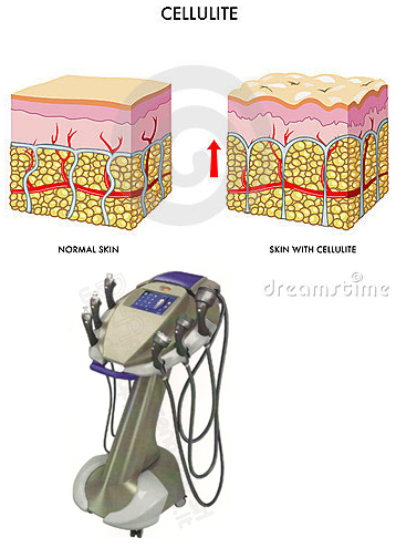 How To Get Of Cellulite - Cellulite Redux