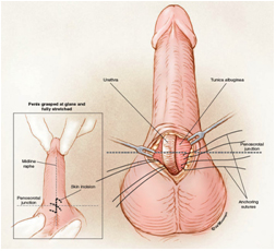 Artificial Penile Nodules