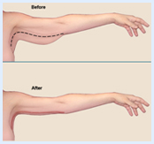 Before and after illustration of an arm showing the results of an arm lift procedure in Costa Rica.