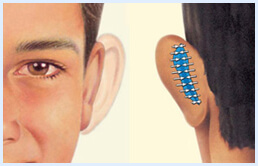 Before and after Illustrations of a man showing how an ear surgery is accomplished.