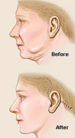 Before and after Illustrations of a showing how a Face lift with neck lift is accomplished.