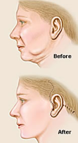 face-lift-with-neck-lift-details Before and after Illustrations of a showing how a Face lift with neck lift is accomplished.