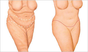 Before and After illustration of the results of a Mommy Makeover procedure in Costa Rica.