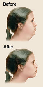 neck-sculpting-details Before and after illustration of a woman’s neck showing the results of a neck sculpting (neck and chin liposuction) in Costa Rica.
