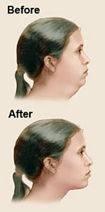 Before and after illustration of a woman’s neck showing the results of a neck sculpting (neck and chin liposuction) in Costa Rica.