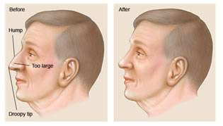 Before and after illustration of a man’s nose showing the results of a nose surgery (Rhinoplasty) in Costa Rica.