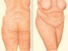 Before and After illustration of the results of a Post Weight-Loss Contouring procedure in Costa Rica.