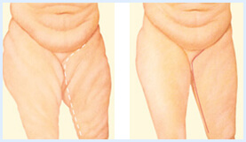 Before and After illustration of the results of a Thigh Lift procedure in Costa Rica.