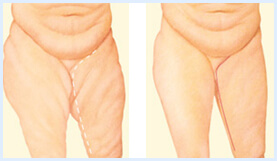 thigh-lift-details Before and After illustration of the results of a Thigh Lift procedure in Costa Rica.