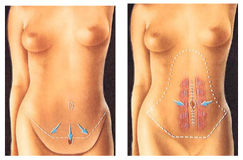 Before and After illustration of the results of a Tummy Tuck procedure in Costa Rica.