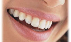 bonding Picture of a smiling woman showing her bonding procedure in Costa Rica.