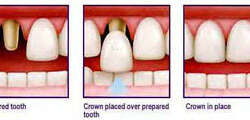 dental-crowns-caps Illustration of teeth in the lower jaw showing how dental crowns or caps are placed in Costa Rica.