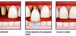 Illustration of teeth in the lower jaw showing how dental crowns or caps are placed in Costa Rica.