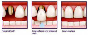 Illustration of teeth in the lower jaw showing how dental crowns or caps are placed in Costa Rica.