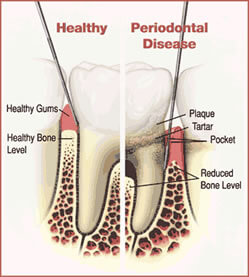 Picture of a Periodontal procedure in Costa Rica.