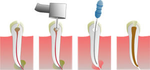 Picture of a Root Canal procedure in Costa Rica.