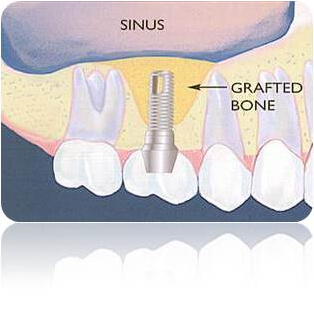 Illustration of a Sinus Lift procedure in Costa Rica.