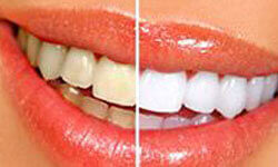 teeth-whitening Picture of a smiling woman happy with her Costa Rica dental whitening.