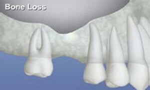 Illustration of an area of the jaw bone where bone loss has occurred.