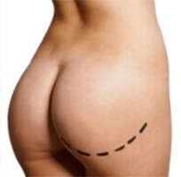 Picture of the results of a Brazilian Buttocks Lift in Costa Rica.