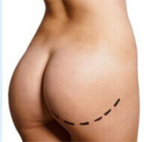 Picture of the results of a Brazilian Buttocks Lift in Costa Rica.