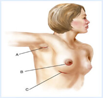 breast-lift-with-implants Illustration of a woman showing how a breast lift is accomplished.