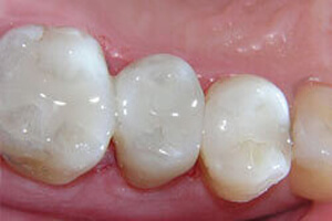 dental-fillings Illustration of how a white dental filling procedure is accomplished in Costa Rica.