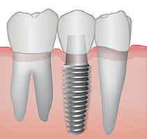 Illustration of how a dental implant with crown procedure is accomplished in Costa Rica.