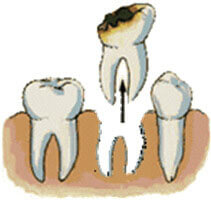 Illustration of how a dental tooth extraction is accomplished.
