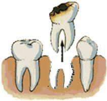 dental-tooth-extraction Illustration of how a dental tooth extraction is accomplished.