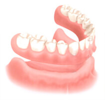denture Illustration of how a denture fits over the gums in the lower jaw.