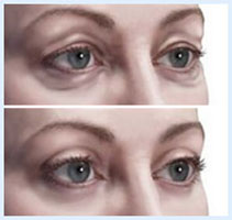 Before and after Illustrations of a showing how an eyelid lift is accomplished.