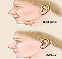 Before and after Illustrations of a showing how a Face lift with neck lift is accomplished.