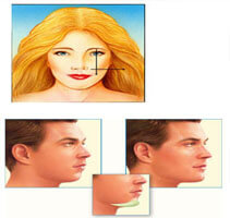 Illustration of a woman and a man showing how facial implants are accomplished.