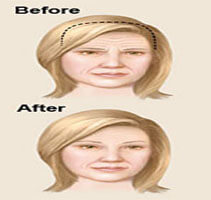 Before and after illustration of a woman showing how Forehead Lift is accomplished.