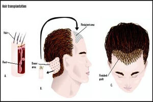 Before and after illustration of a man’s head showing the results of a neck sculpting hair transplant procedure in Costa Rica.