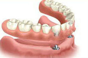 Picture of an implant supported denture procedure in Costa Rica.