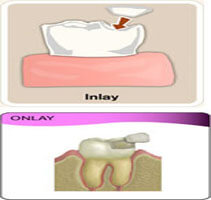 Picture of an inlay and onlay procedure in Costa Rica.