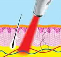 Illustration of a Fractional CO2 laser as it treats acne.