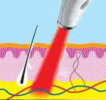 laser-acne-treatment Illustration of a Fractional CO2 laser as it treats acne.