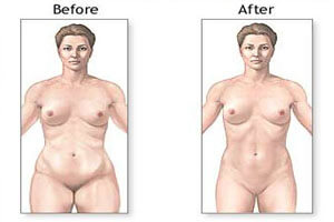 Before and After illustration of the results of a Liposculpture procedure in Costa Rica.