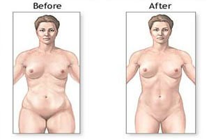 liposculpture Before and After illustration of the results of a Liposculpture procedure in Costa Rica.