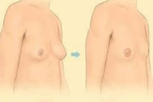 Before and After illustration of a male breast reduction procedure as performed in Costa Rica.