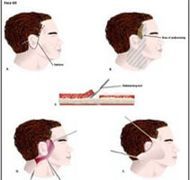 Illustration of how a male face lift with neck lift is performed in Costa Rica..