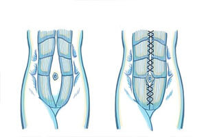 Before and After illustration of the results of a Male Tummy Tuck procedure in Costa Rica.