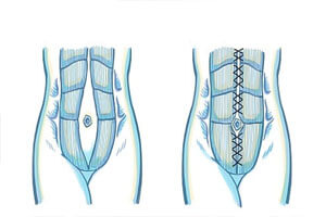 male-tummy-tuck Before and After illustration of the results of a Male Tummy Tuck procedure in Costa Rica.