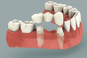 Illustration of teeth in the lower jaw showing how a three unit bridge is made in Costa Rica.