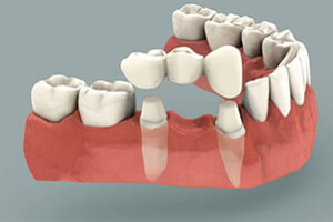 three-unit-bridge Illustration of teeth in the lower jaw showing how a three unit bridge is made in Costa Rica.