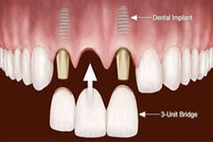 Illustration of how a 3 unit implant-supported bridge procedure is accomplished in Costa Rica.